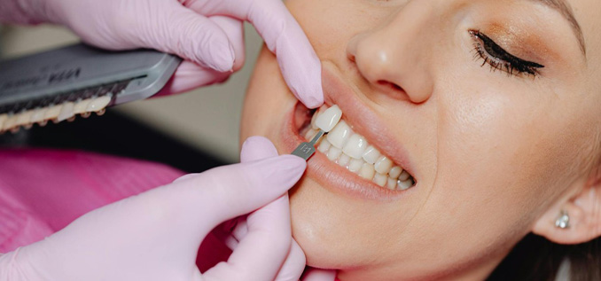 A Guide to Dental Veneers 